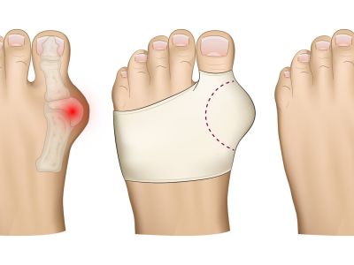 Bandáže na hallux: mäkká ochrana palca, pohodlie pri chôdzi a menší tlak v obuvi