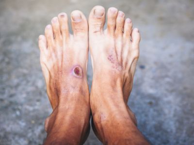 Starostlivosť o nohy diabetikov Starostlivosť o nohy diabetikov